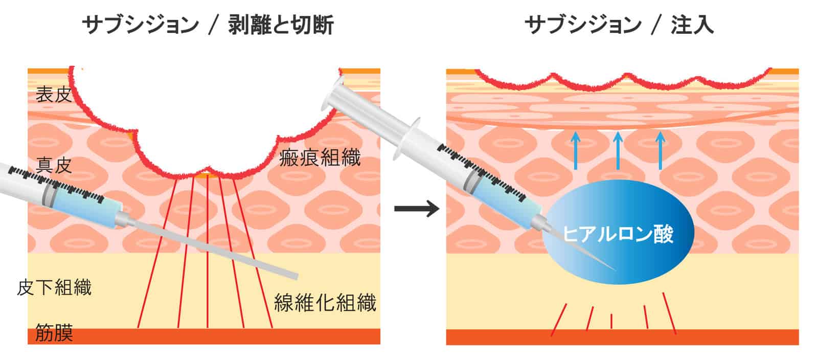 ニキビ跡の凹み治療｜クレーター改善専門｜肌のクリニック東京