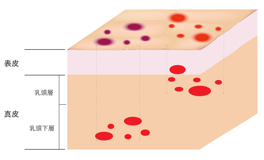 ニキビ跡の赤み
