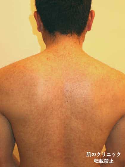 After treatment of severe acne on the back