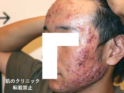 3 Before Severe Acne Treatment