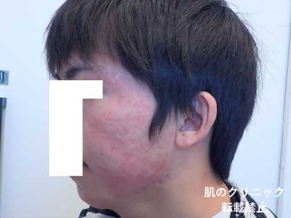 8 After Severe Acne Treatment