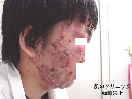 4 Before Severe Acne Treatment