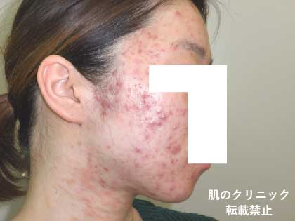 Severe Acne 2 in Women