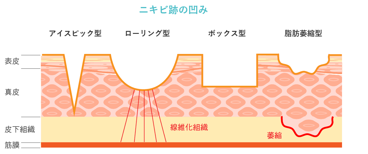 ニキビ跡の凹み