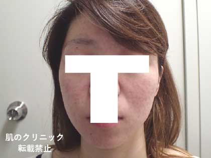 Isotretinoin (Accutane) for Acne Treatment | 肌のクリニック・高円寺院・麹町院 | 医療脱毛 ニキビ  AGA シミ治療