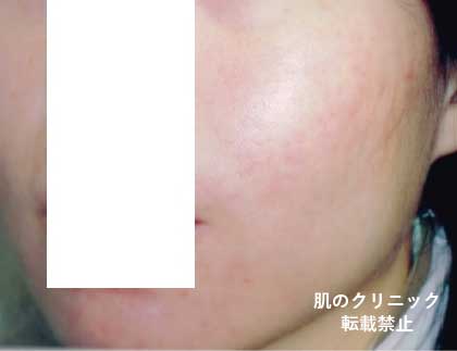 Reddened Face and Red Acne After Treatment
