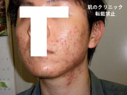 Severe acne