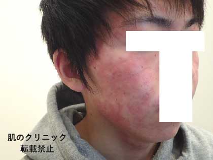 4 After Severe Acne Treatment