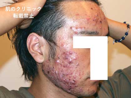 1 before severe acne treatment