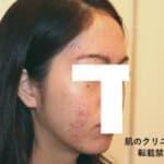 小さい赤ニキビ