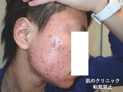 Worsening of red and white acne