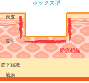 ボックス型ニキビ跡