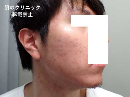 After treatment of severe acne