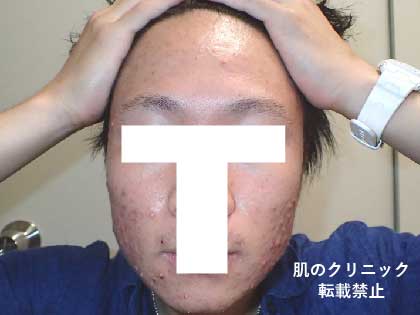Worsening of red and white acne