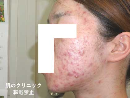 Severe Acne in Women 1