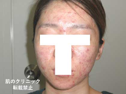 Women Severe Acne 3