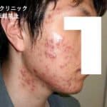 重症にきび