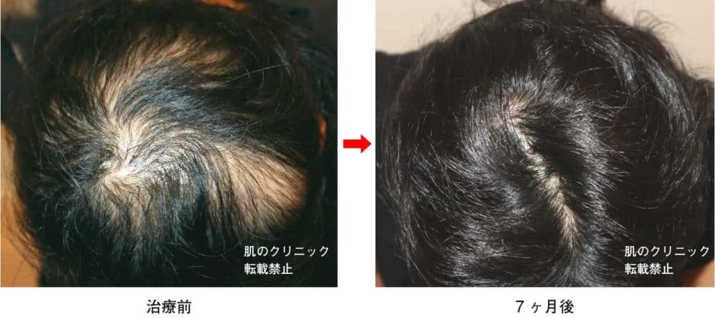 Thinning hair treatment for women