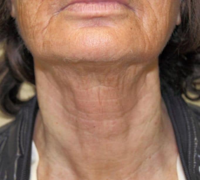 Ultra Former 3 neck wrinkle after-photo