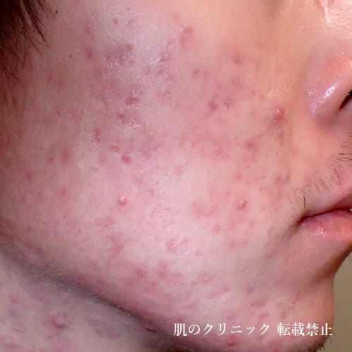 Red acne scars