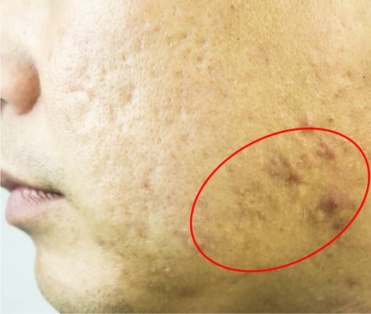 Hypertrophic scarring of the face line
