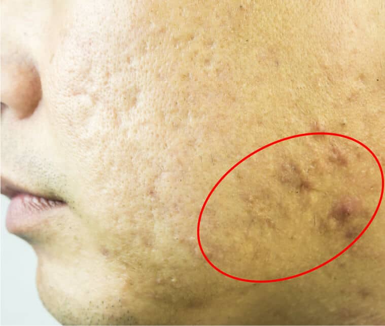 hypertrophic acne scar