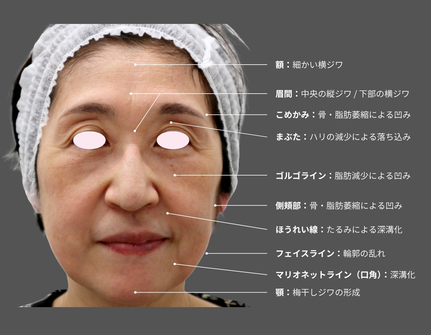 60代女性の正面顔写真（ヒアルロン酸注入前の術前評価）。額や眉間のシワ、こめかみ・頬の凹み、上まぶたの落ち込み、ゴルゴライン、ほうれい線、マリオネットライン、顎の梅干しジワ、フェイスラインのたるみなど、加齢によるボリュームロスと輪郭の崩れを示す。