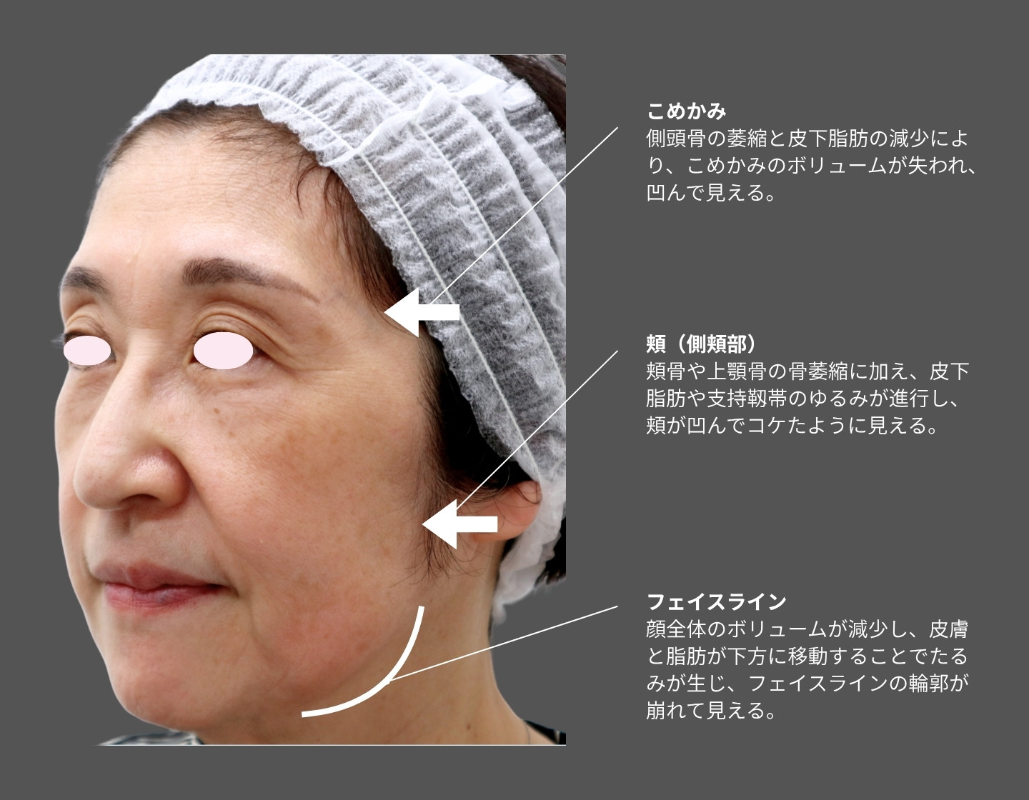 60代女性の顔写真。こめかみと頬が痩せて凹み、頬の下垂によりフェイスラインが崩れた加齢性変化を示す。輪郭が緩み、顔全体がややピーナッツ型（ひょうたん型）に見える状態。