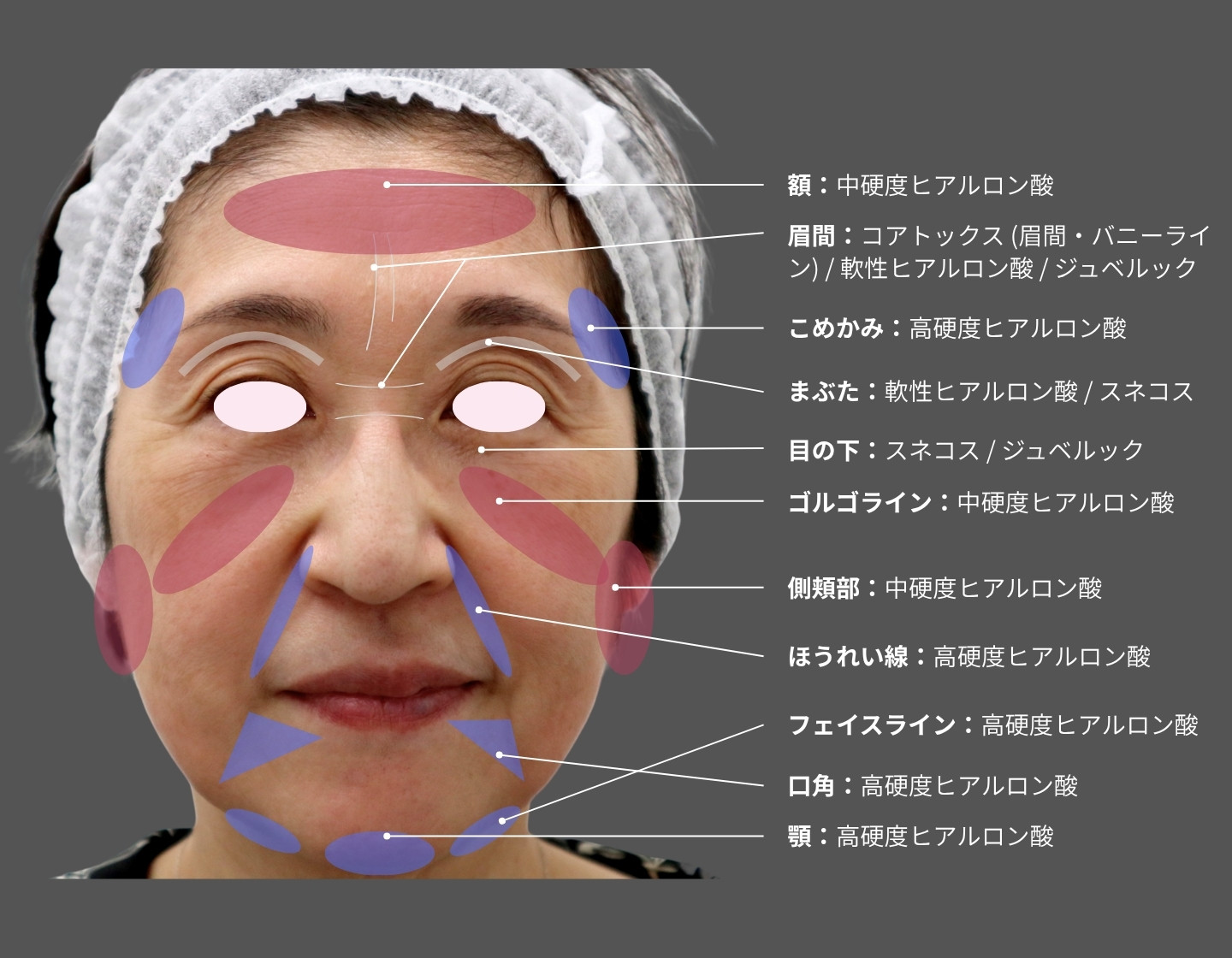 60代女性の顔写真を用いたヒアルロン酸注射の治療計画図。額・こめかみ・頬・口周り・フェイスラインなど、部位ごとに使用する製剤を示している。軟性・中硬度・高硬度ヒアルロン酸を使い分け、コアトックス、スネコス、ジュベルックを併用した総合的な若返りデザインを示す。
