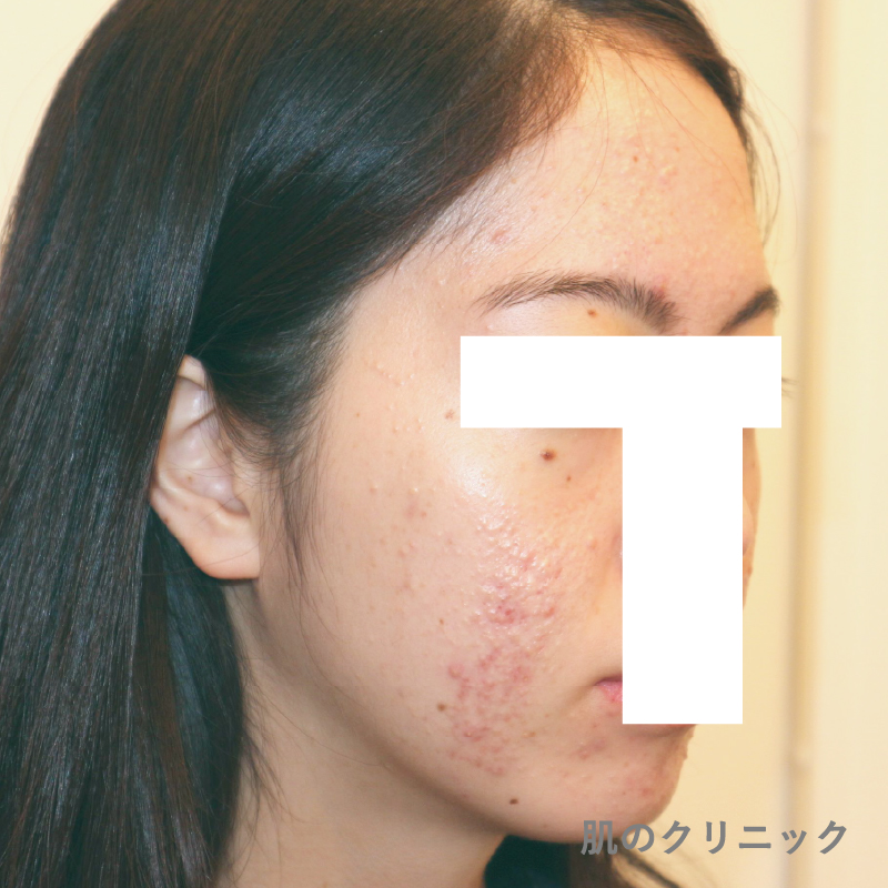 ピル内服中にも関わらず発症した20代女性の右側面ニキビ写真。頬と顎を中心に多発する紅色丘疹と小膿疱が見られるホルモン治療前の状態