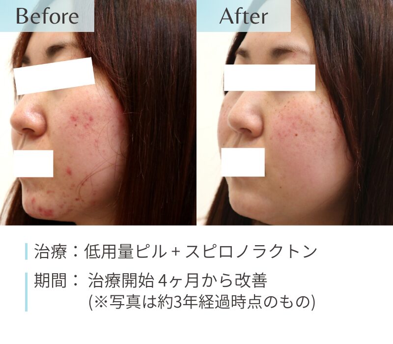 ホルモン療法による30代女性の側面から見た頬と顎のニキビ改善例。治療前の炎症性ニキビが治療後に顕著に減少した臨床写真