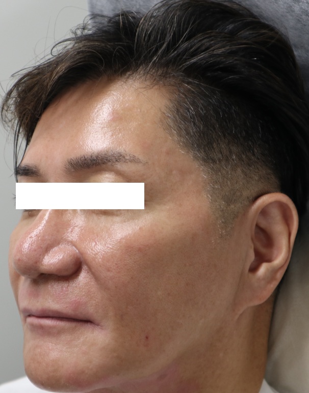 50代男性のヒアルロン酸注射アフター写真(左側)。
