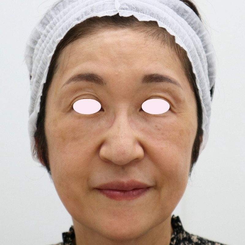 60代女性のヒアルロン酸注射アフター写真（正面）。ほうれい線やマリオネットラインが浅くなり、額や瞼の印象が明るく、中顔面からこめかみ・頬にかけて自然にふっくらし、顔全体の骨格が整い若々しい印象に。