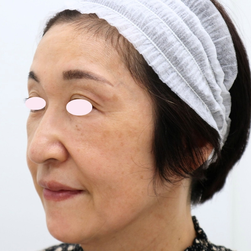 60代女性のヒアルロン酸注射アフター写真（左側面）。上まぶたやこめかみ、頬のボリュームがふっくらと回復し、顔全体が明るく若々しい印象に整った。