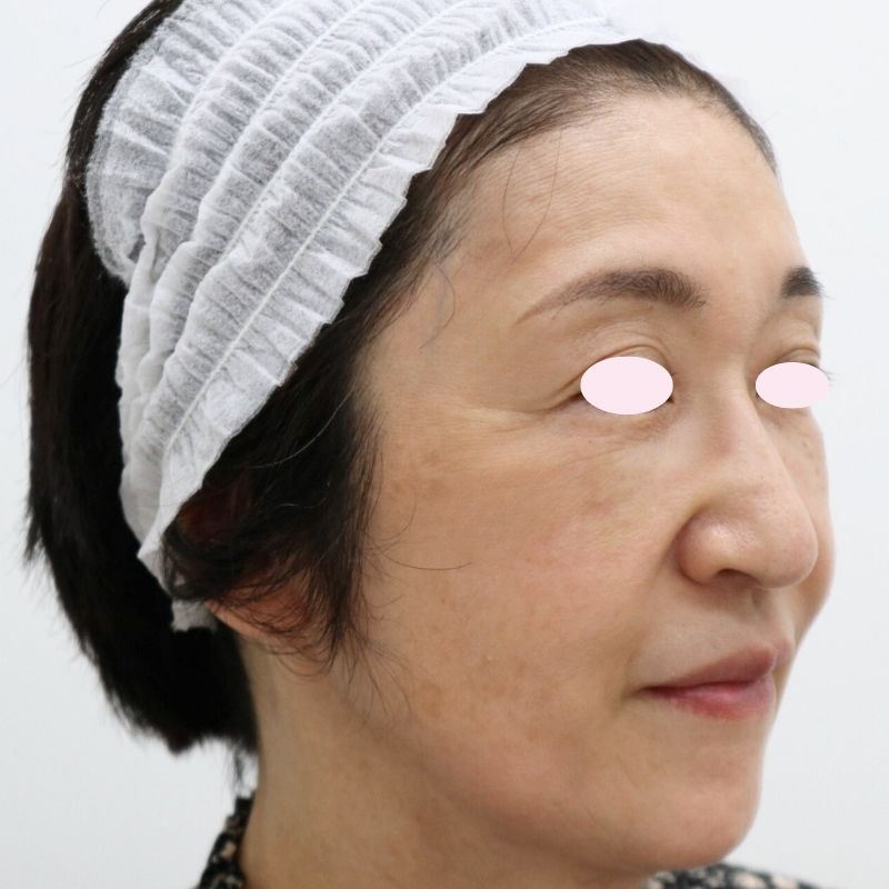 60代女性のヒアルロン酸注射アフター写真（右側面）。頬とこめかみのボリュームが自然に回復し、フェイスラインが引き締まって顎のシワも目立たなくなった。