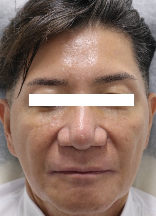 50代男性のヒアルロン酸注射ビフォー写真(正面)。
