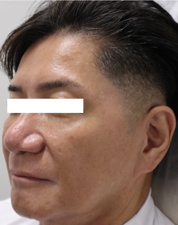 50代男性のヒアルロン酸注射ビフォー写真(左側)。