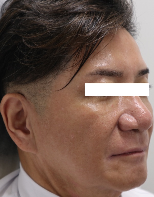 50代男性のヒアルロン酸注射ビフォー写真(右側)。