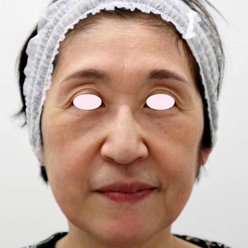 60代女性のヒアルロン酸注射ビフォー写真（正面）。ほうれい線やマリオネットラインが目立ち、額のシワ、瞼の落ち込み、中顔面やこめかみ、頬のボリューム減少が見られる。