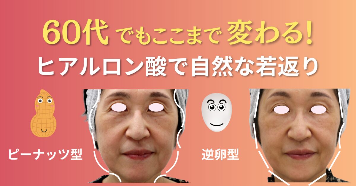 60代女性がヒアルロン酸注射で逆卵型の輪郭になり、自然に若返っているビフォーアフター写真。