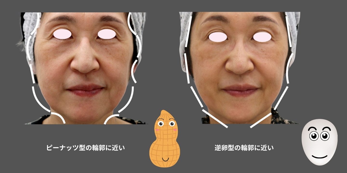 60代女性のヒアルロン酸注射によるビフォーアフター。こめかみと側頬部の凹みが改善し、ピーナッツ型の輪郭から逆卵型の輪郭へ整い、小顔効果が得られた様子