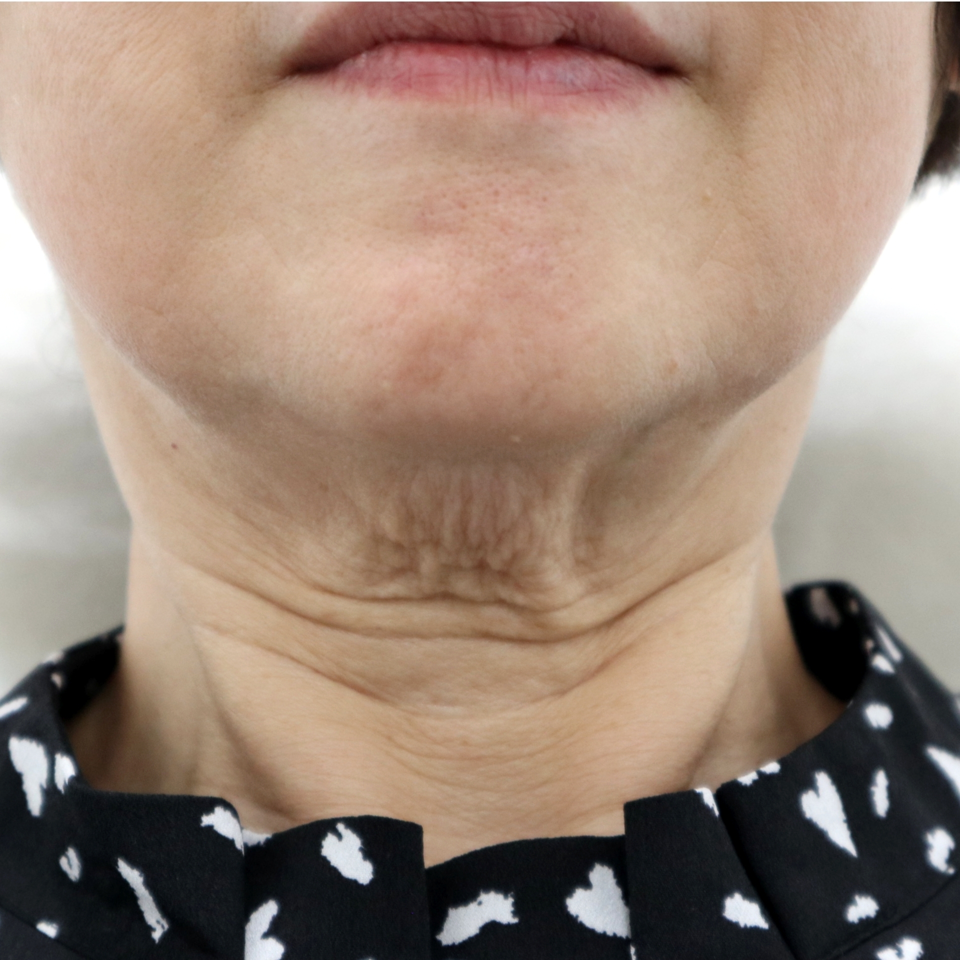 首のシワでお悩みの60代女性患者様（治療前の症例写真）