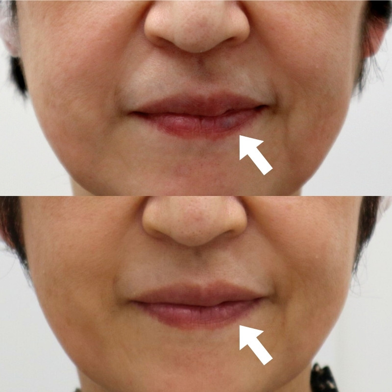 唇の静脈湖（Venous lake）のビフォーアフター写真。上段は治療前で青紫色の血管性病変が見られ、下段は血管治療レーザー照射後で病変が消失し、色調が均一になった状態を示す。