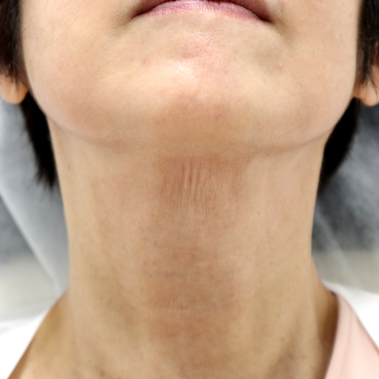 首のシワ治療後の60代女性患者様 仰向けの角度での改善結果