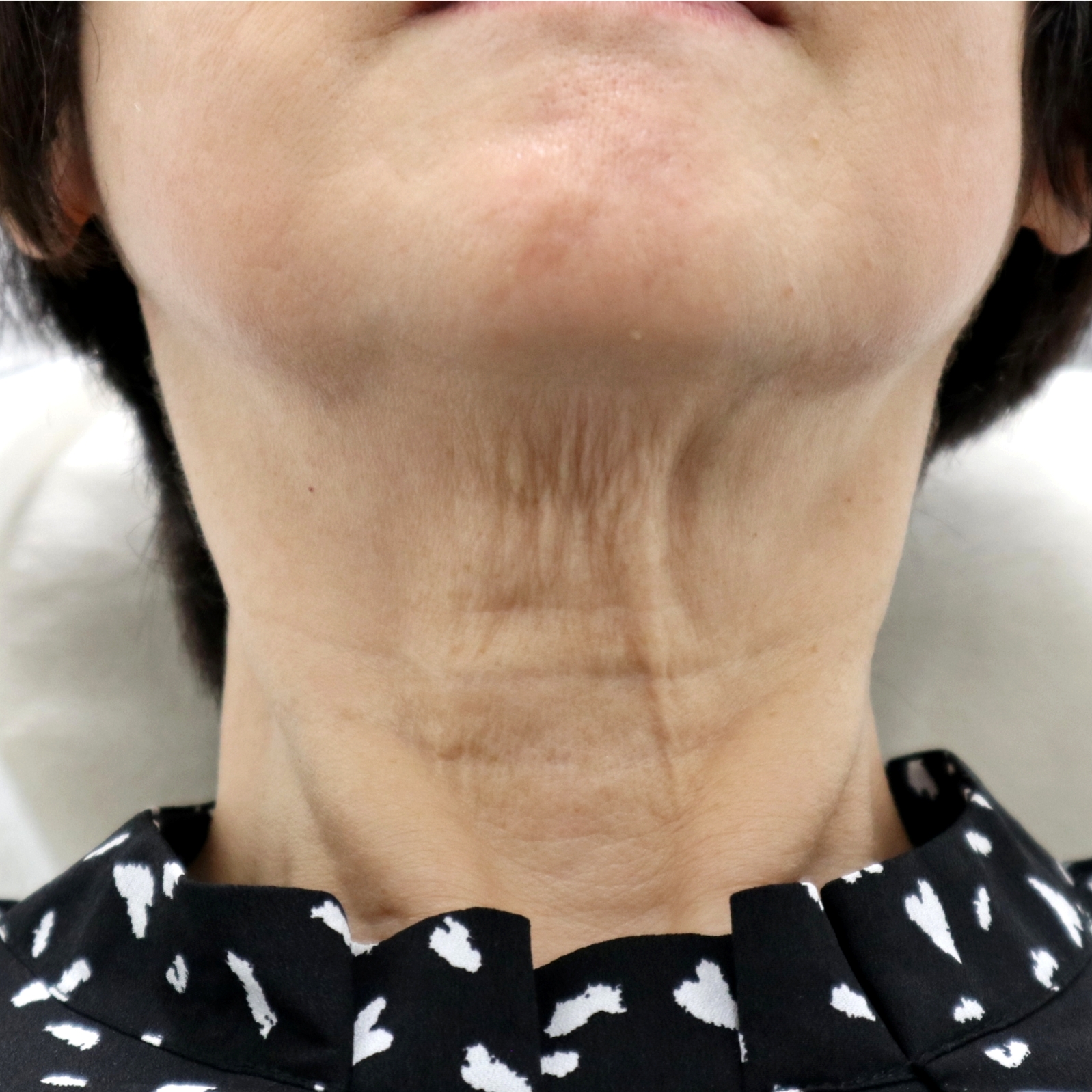 首のシワ治療前の60代女性患者様 顎を上げた角度での症例写真