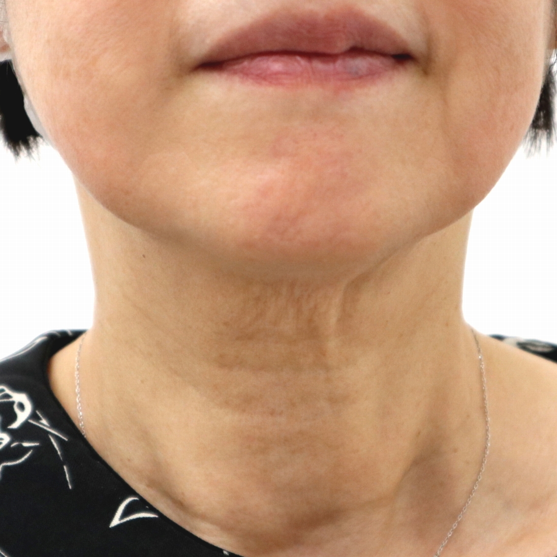 首のシワ治療前の60代女性患者様 正面から見た症例写真