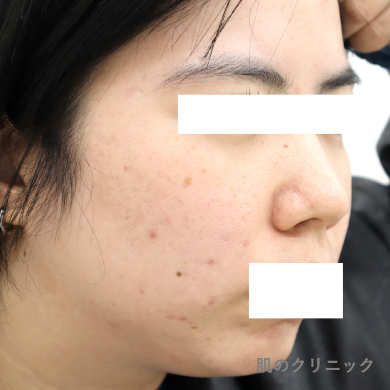 多嚢胞性卵巣症候群の20代女性患者の低用量ピルとスピロノラクトン治療後の側面写真。ホルモンバランス改善により頬と顎の炎症性ニキビが著しく軽減