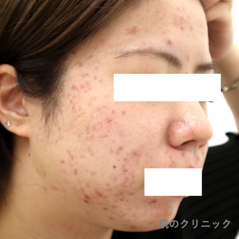多嚢胞性卵巣症候群の20代女性患者の治療前側面写真。低用量ピルとスピロノラクトン治療前の頬と顎の重度炎症性ニキビ状態