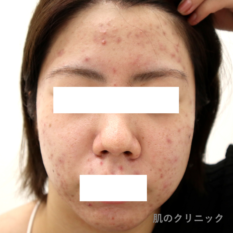 多嚢胞性卵巣症候群による20代女性の重症ニキビ治療前の正面写真。ホルモンバランスの乱れによる顔全体の炎症性ニキビと赤みが顕著に見られる