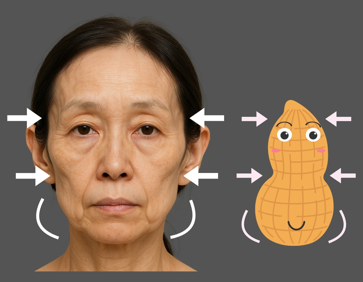 中年以降の女性の顔の輪郭変化を示す画像。こめかみと頬のボリュームが減少し、ピーナッツのように中央がくびれた輪郭（ピーナッツ型・ひょうたん型）になる加齢変化を視覚的に表現。